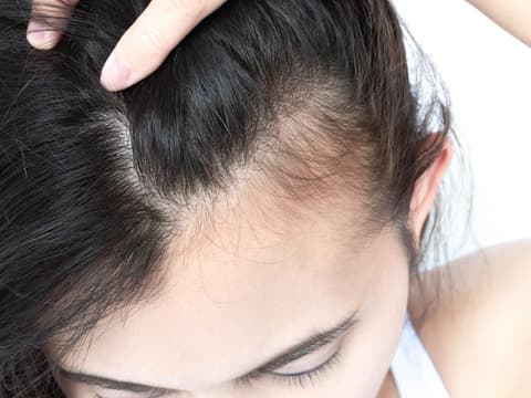Frau mit dünnen Haaren