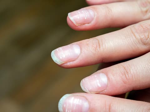 Weiße Flecken auf Fingernägeln
