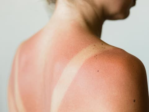 Frau mit Sonnenbrand
