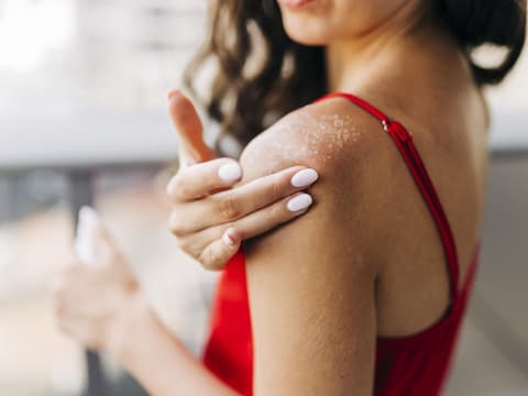 Haut pellt nach Sonnenbrand