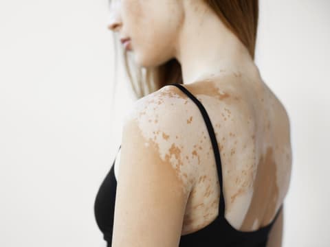 Frau mit Vitiligo-Störung am Rücken