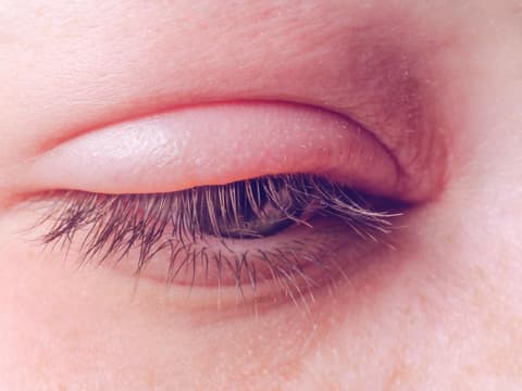 Infektion am Auge