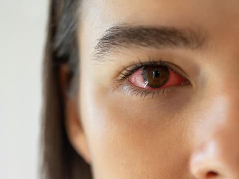 rotes Auge