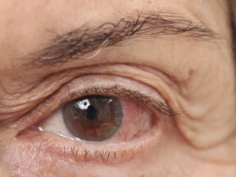 Auge eines älteren Mannes mit Bindehautentzündung zeigt Symptome wie Rötungen und Schwellungen