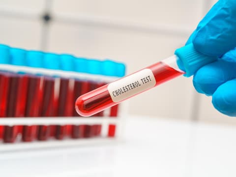 Blutprobe eines Cholesterin Tests