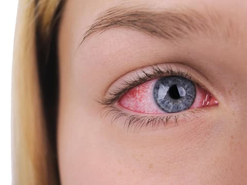 Thrombose im Auge