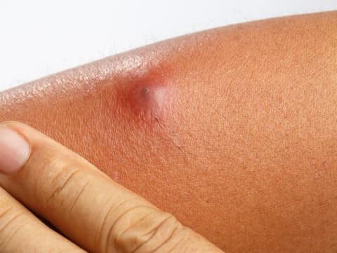 Ein Abszess auf einem Arm