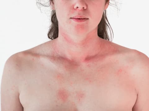 Dermatomyositis