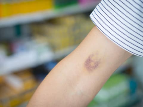 Kreisrunder Bluterguss auf einem Arm