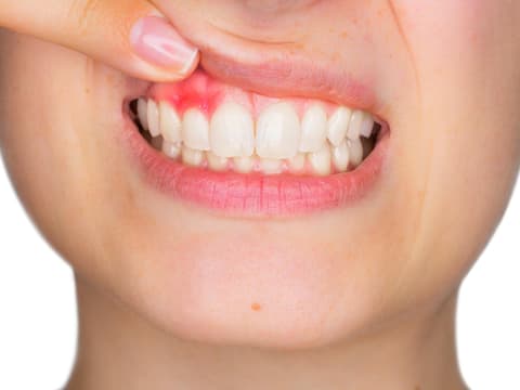 Frau zieht Lippe hoch um Zahnfleisch zu zeigen