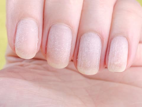 Gelbe und trockene Fingernägel