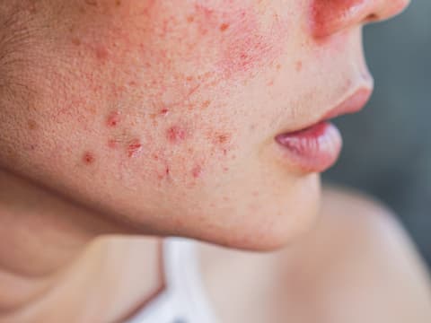 Frau mit Röschenflechte im Gesicht