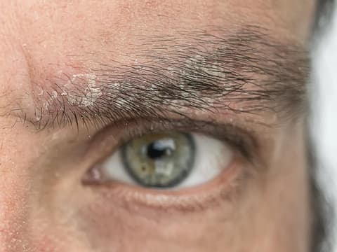 Mann mit schuppigen Augenbrauen