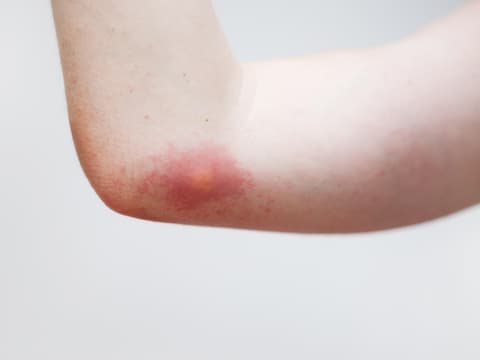 Wespenstich am Arm