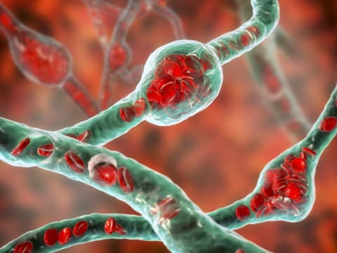 Aneurysma im Kopf geplatzt