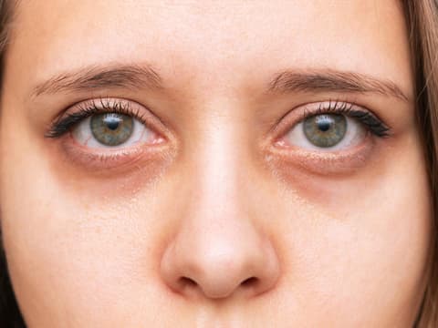 junge Frau mit eingefallenen Augen und dunklen Augenringen