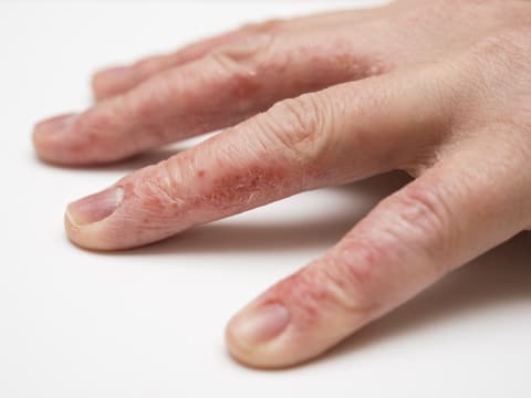 Wenn sich die Fingerkuppen schälen, ist die Ursache meist harmlos.