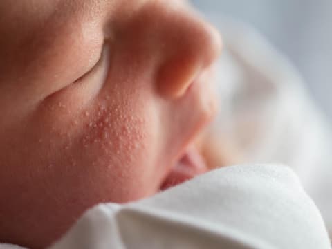 Nahaufnahme eines Hitzeausschlags auf der Wange eines Säuglings