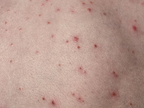 Haut mit roten Pusteln darauf