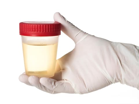 Hand hält Urinprobe in der Hand
