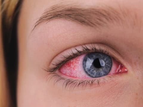 Frau mit geröteten Augen 