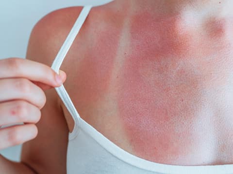 Frau mit Sonnenbrand auf der Brust