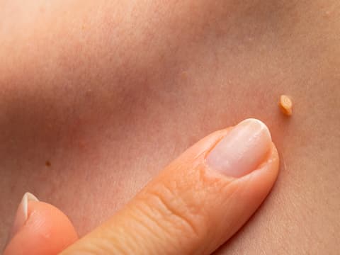 Harmlose Hautknoten oder Grund zur Sorge?
