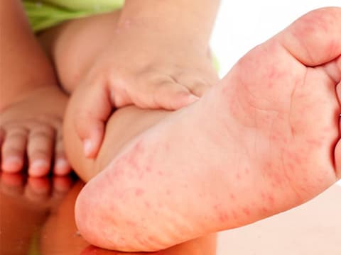 Hand-Fuß-Mund-Krankheit bei Kindern