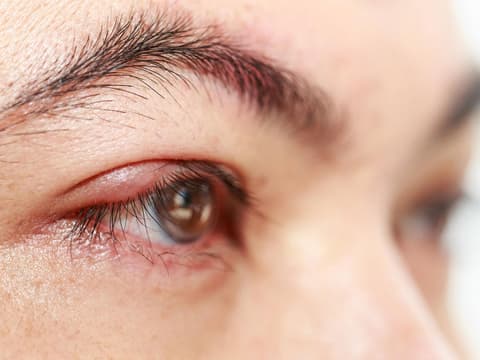 Gerstenkorn Entzuendung am Auge