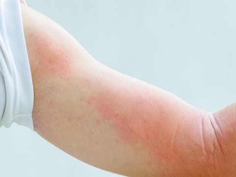 Nesselsucht als allergiesche Reaktion