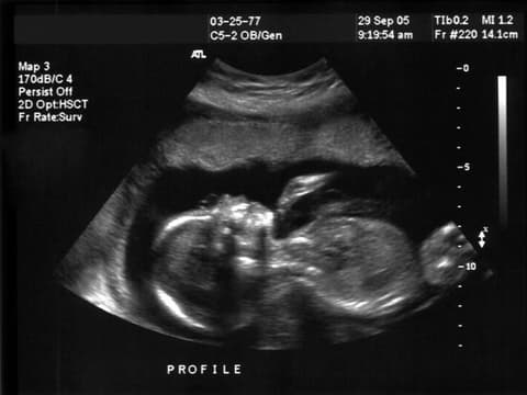Baby im Mutterleib auf Ultraschallbild