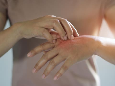 Frau kratzt sich an geröteter Hand, Neurodermitis
