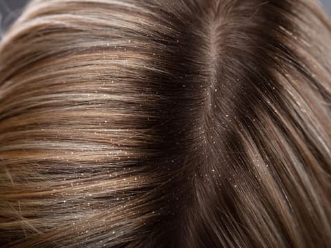 Schuppen können verschiedene Ursachen haben