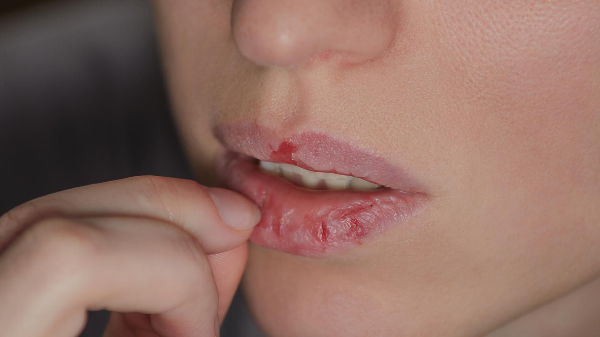 Spr-de-Lippen-5-Hausmittel