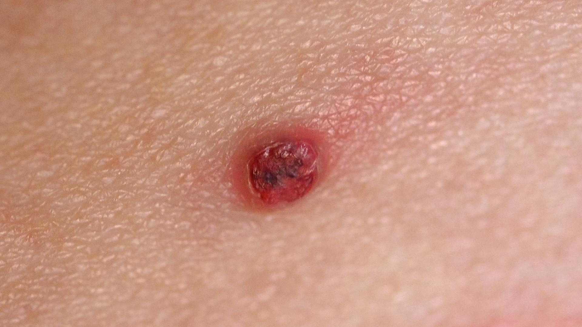 Was Passiert Wenn Man Ein Muttermal Aufkratzt www.vital.de