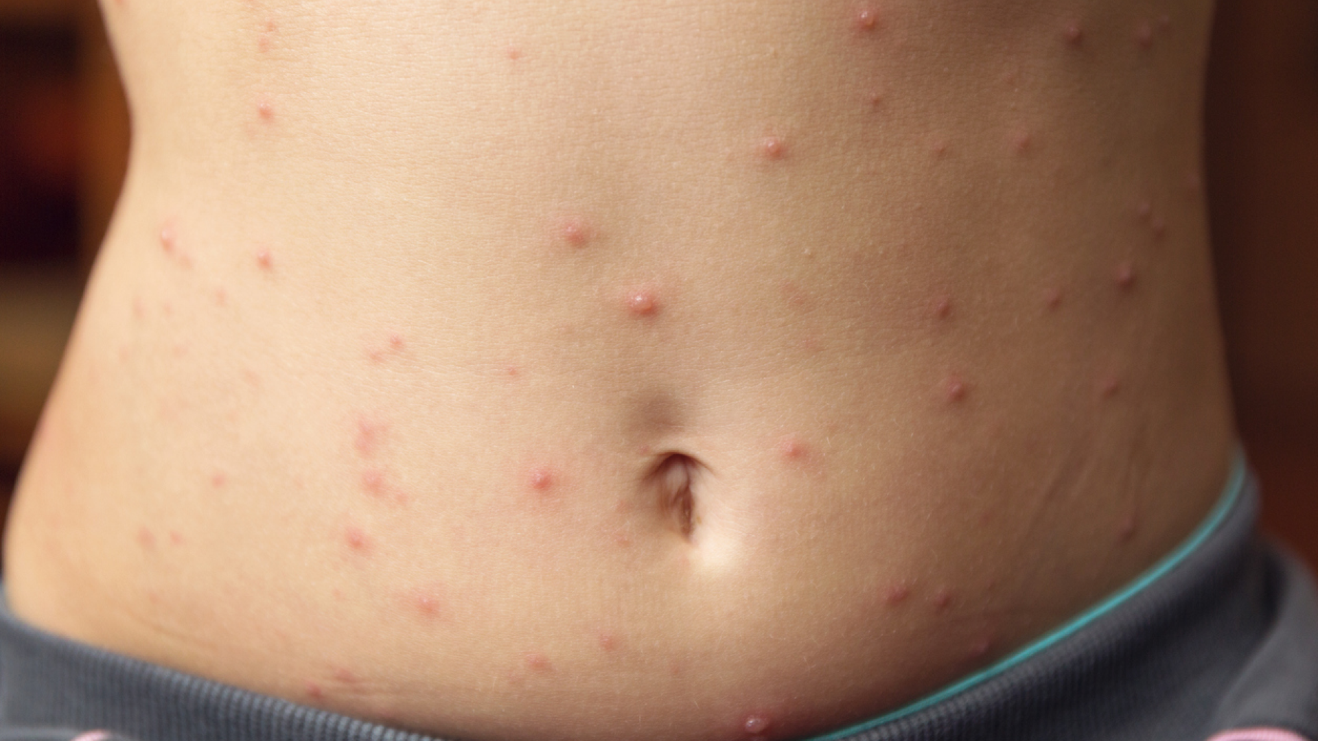 Rote-Flecken-am-Bauch-Sind-die-winzigen-roten-Punkte-gef-hrlich-