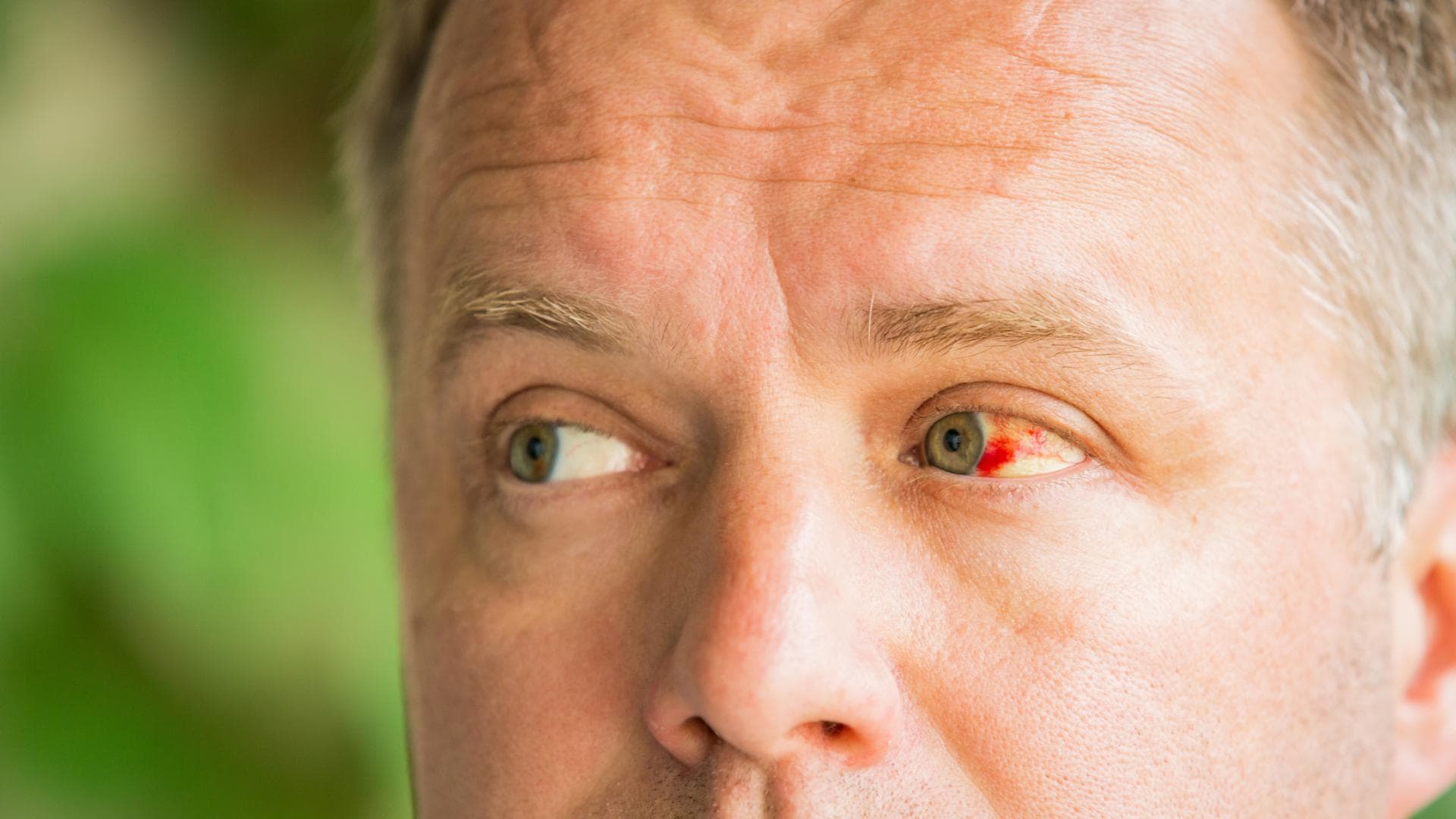 Geplatzte Ader im Auge Was tun bei blutroten Augen?