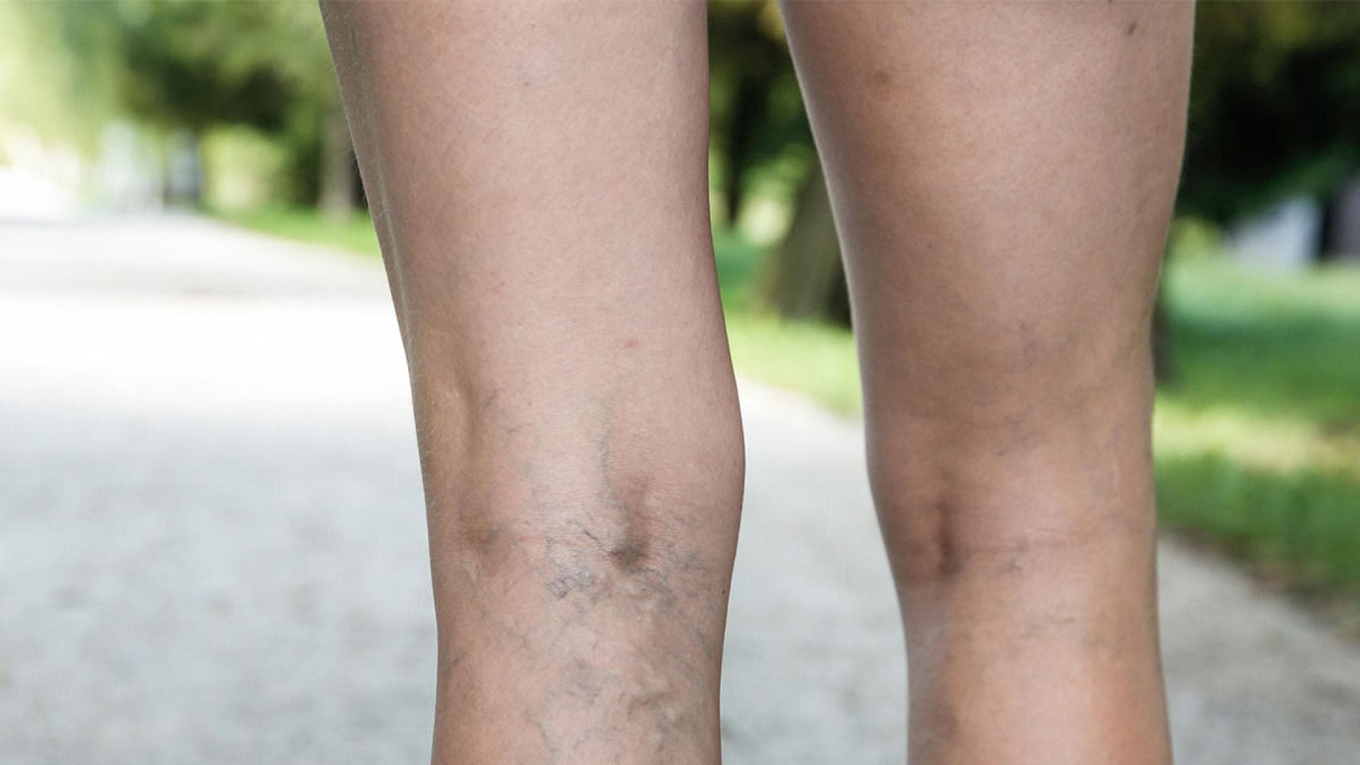 Wie Erkenne Ich Thrombose In Der Schwangerschaft