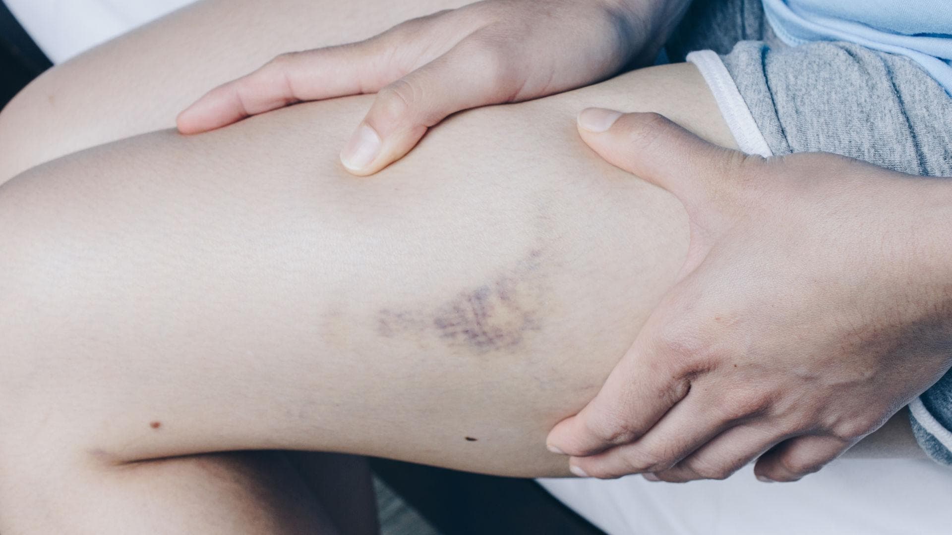 darum bekommen frauen leichter blaue flecke