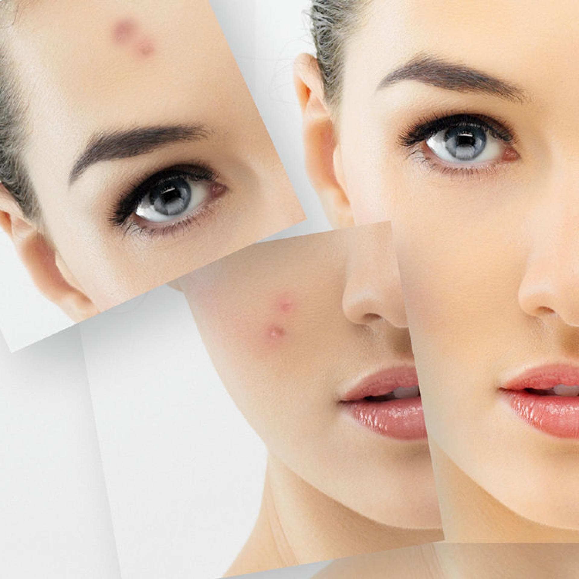 Der Kampf Gegen Rosacea