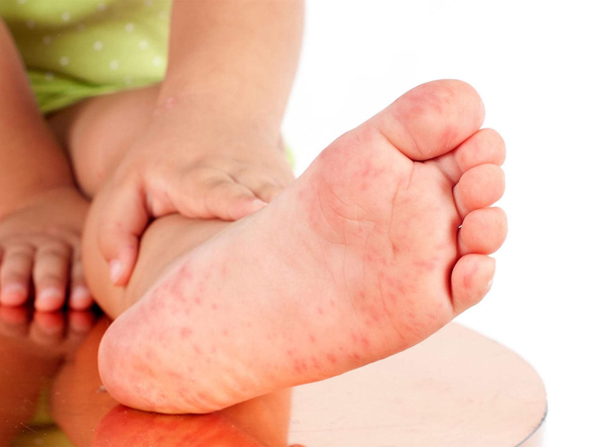 Hand Mund Fuss Krankheit
