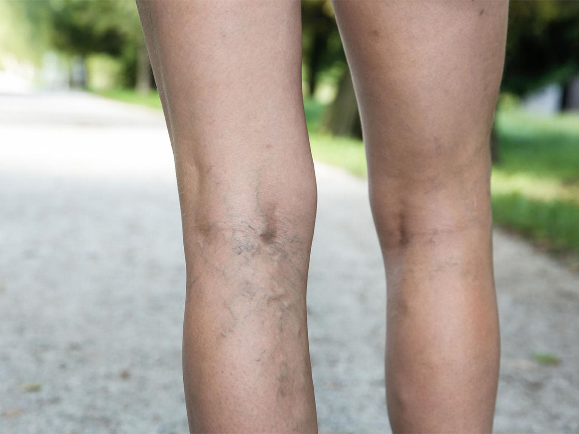 Thrombose Wenn Die Beine Schmerzen