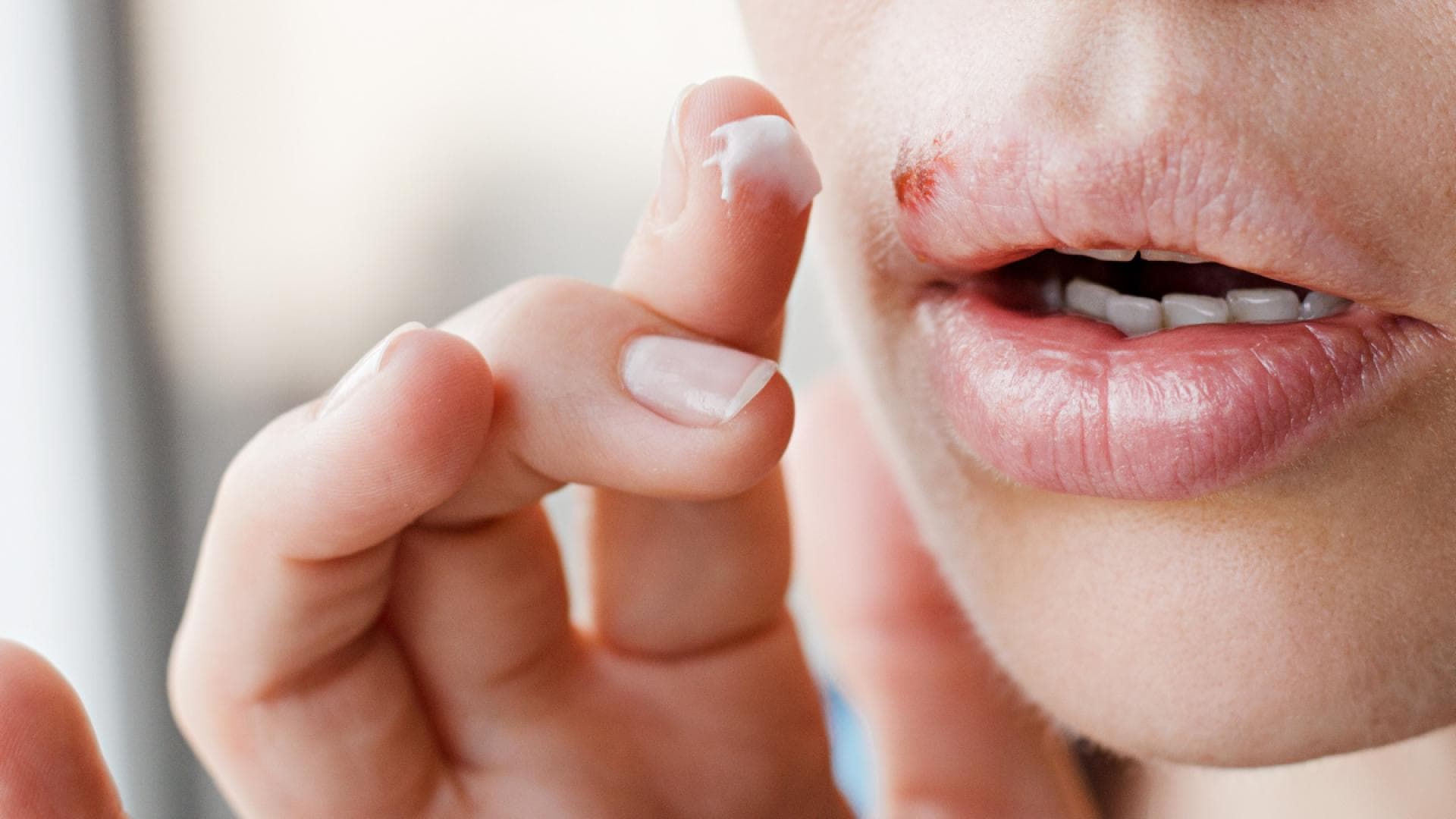 An Lippenherpes erkrankt Symptome und Verlauf