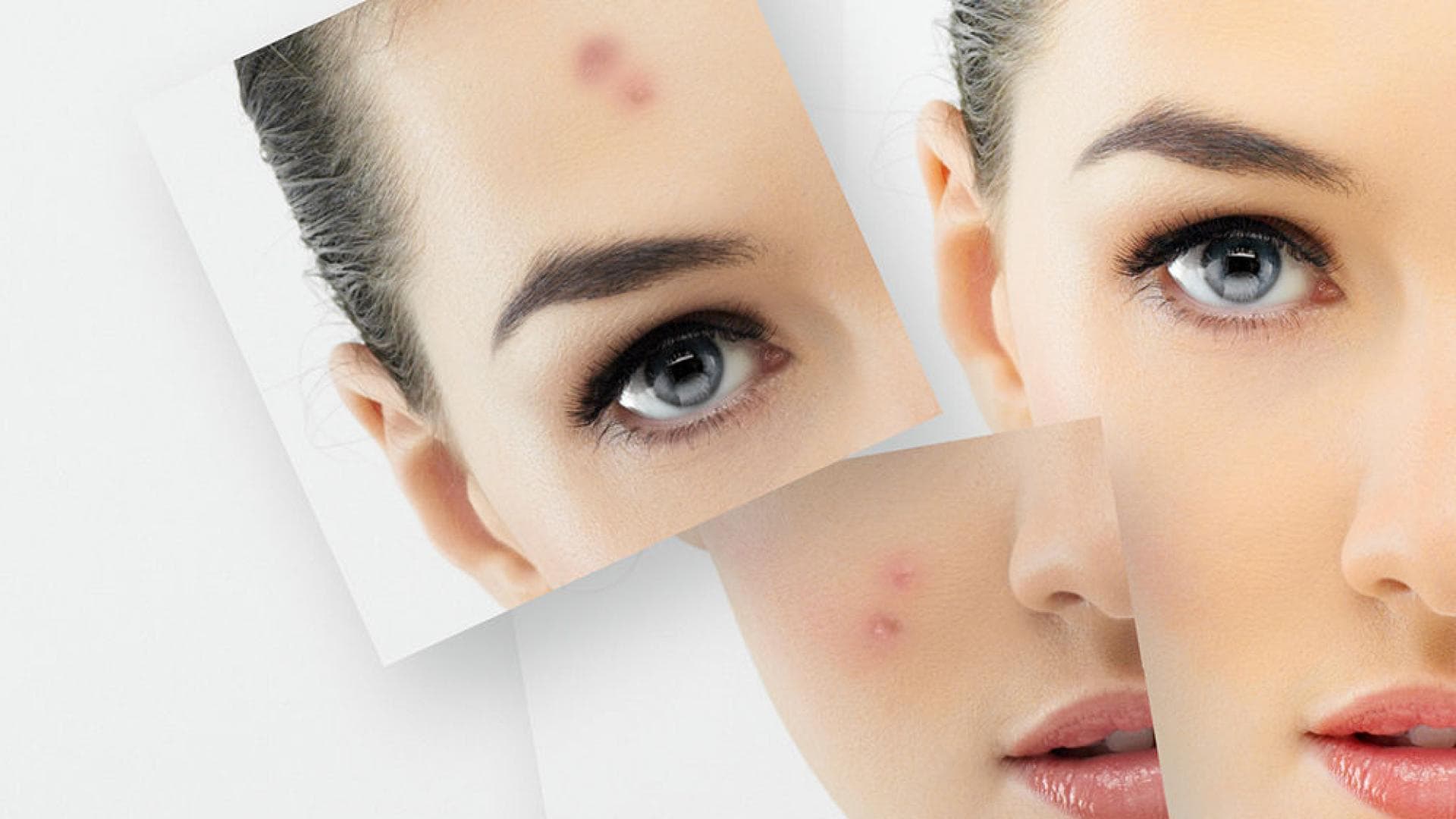 Der Kampf Gegen Rosacea