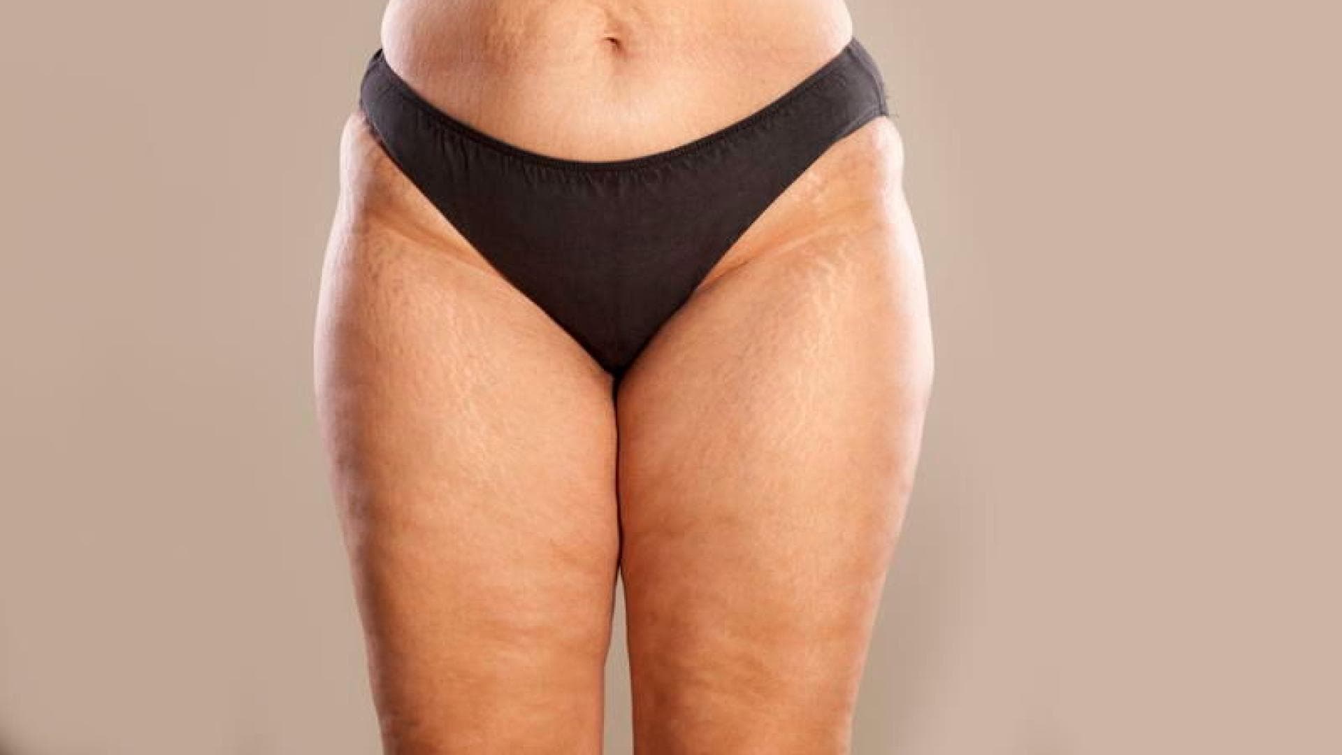 Krankheitsbild Was Ist Lipodem Wie Wird Es Behandelt