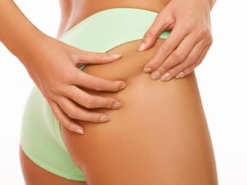 Cellulite am Oberschenkel einer Frau Cellulite am Oberschenkel einer Frau