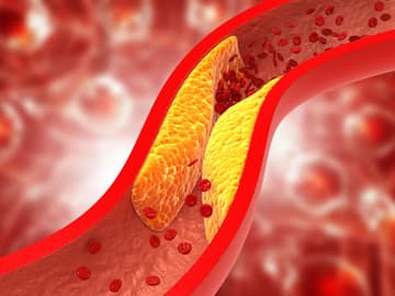 Verstopfte Arterien Verstopfte Arterien