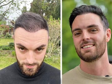 Mann Vergleich nach Haartransplantation Endergebnis Vergleichsbild von einem Mann kurz nach der Haartransplantation bei Elithair und das Endergebnis