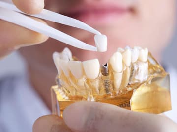 so-funktionieren-moderne-zahn-implantate so-funktionieren-moderne-zahn-implantate
