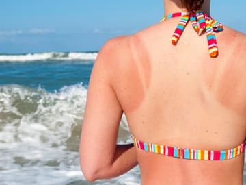 Hausmittel-bei-Sonnenbrand Schnelle Hilfe bei Sonnenbrand